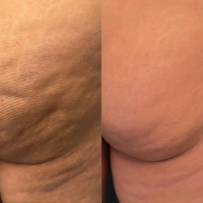 Valeo Sculpt Contour CS-1 results photo 2