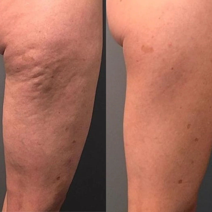 Valeo Sculpt Contour CS-1 results photo 4